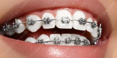 filmes sobre aparelho dentário